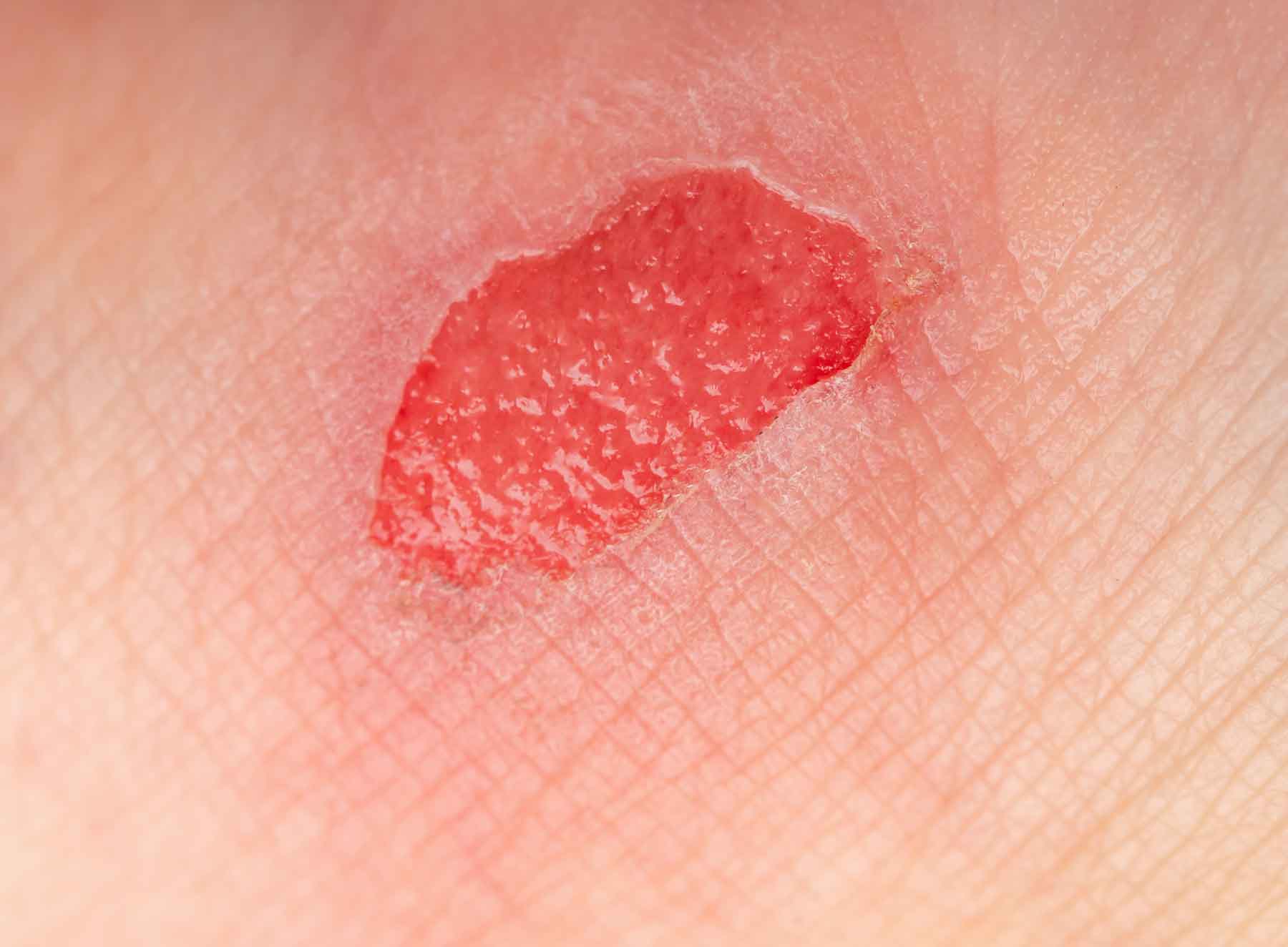 Wundheilung und Regeneration durch Laserbehandlung